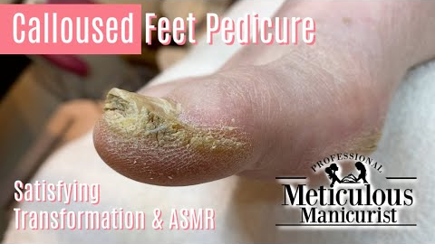 👣How to Pedicure Extremely Calloused Feet and Toes ASMR👣