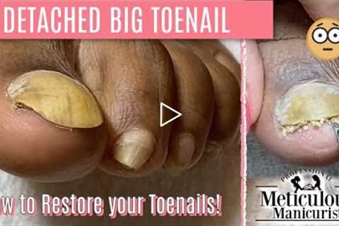 👣How To Pedicure Transformation for Men on Detached Toenails👣