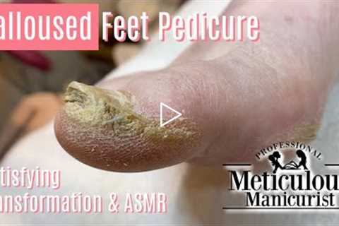 👣How to Pedicure Extremely Calloused Feet and Toes ASMR👣