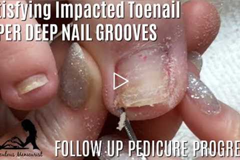 👣 Relaxing Impacted Toenail Pedicure Tutorial ASMR Massage 👣