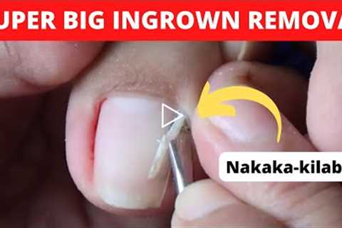 Ingrown Toenails Treatment-Alma's Manicure and Pedicure Vlogs-Joyful Initial Result