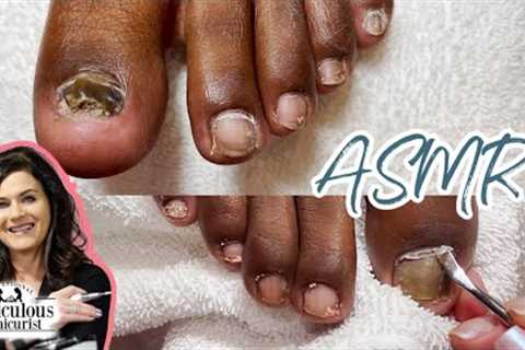 👣Big Toenail Cleaning Transformation ASMR👣