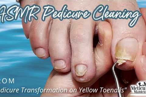👣ASMR Pedicure Cleaning 💆‍♀️ Pedicure Transformation on Yellow Toenails👣
