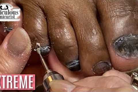 👣Extreme Cuticle Impacted Removal #ASMR Pedicure👣