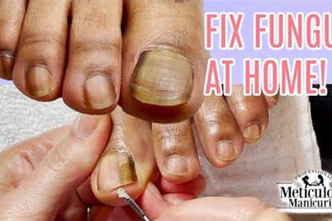 👣Toenail Fungus Cleaning at Home Success👣