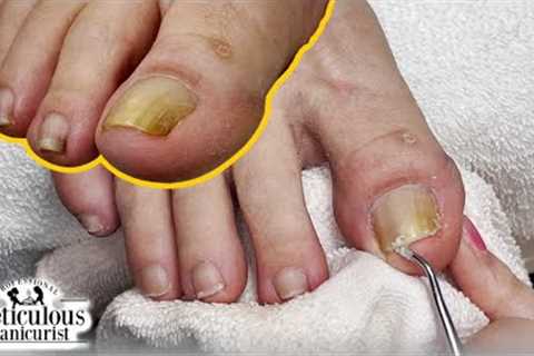 👣How to get rid of Yellow Toenails👣