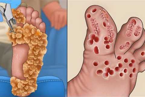 ASMR Pedicure contagious viral warts all over the feet | Foot care animation