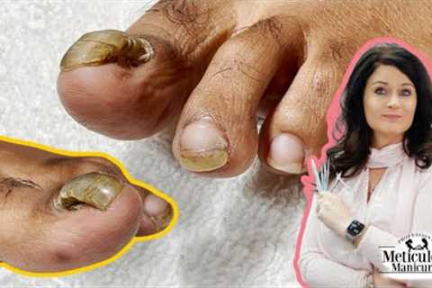 👣Tutorial on How to Care & Treat a Detached Toenail with a Pedicure👣