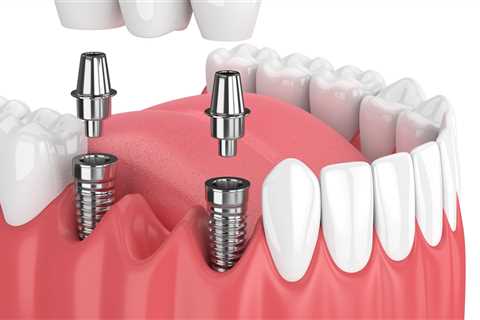 A Lasting Solution: How Dental Implants Transform Tooth Loss