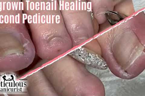 👣 How To Heal Ingrown Toenail at Home Salon Pedicure Second Visit 👣