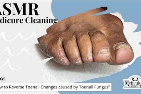 👣ASMR Pedicure Cleaning💆‍♀️How to Reverse Toenail Changes caused by Toenail Fungus👣