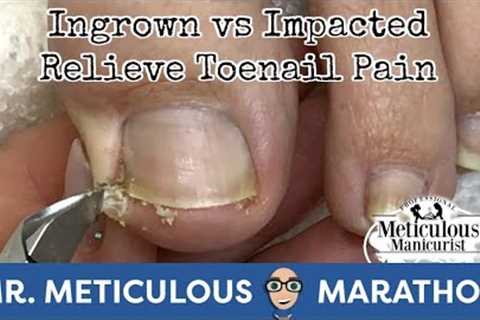 👣Ingrown Toenail and Impacted Toenail Relief and Prevention👣#MrMeticulousMarathon