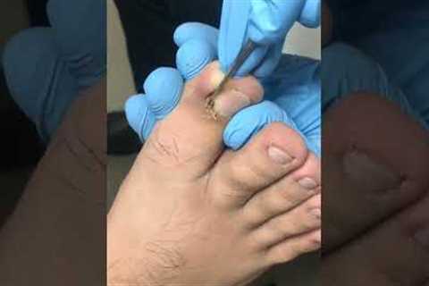 ASMR Pedicure Tutorial #Shorts #ingrown #pedicure #toenail #youtubeshorts (3)