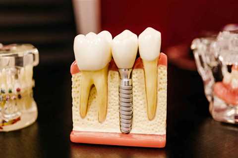 What are the Side Effects of a Tooth Implant