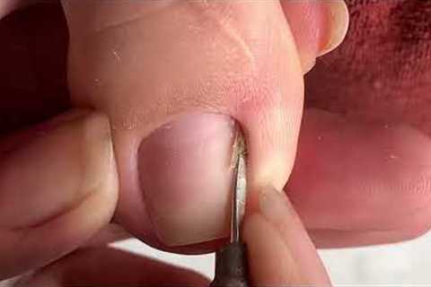 Clean the Skin and remove the corner of the nail#433