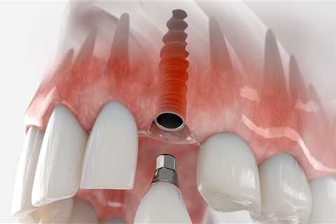 How Painful Is Denture Implants