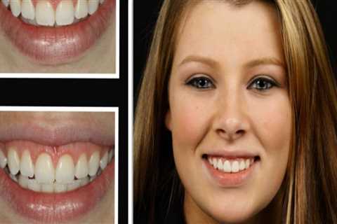 Tooth Recontouring: A Cosmetic Dentistry Procedure