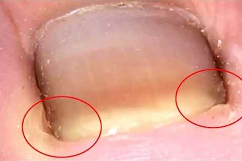 The front end of the ingrown toenail is inflamed, dig it out【Crazy pedicure room】