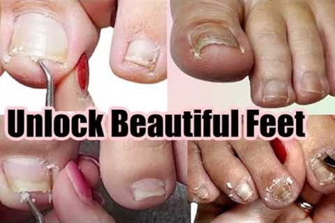 Transform Your Feet: Pedicure Compilation for Impacted, Ingrown, + Pincer Toenails (part 2)