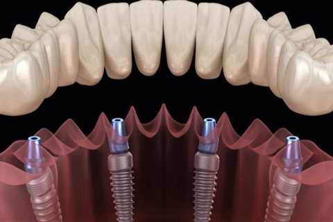 Which type of Dental Implants are Best