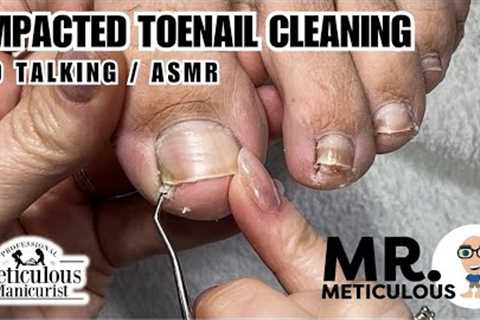 👣How to Fix Ingrown / Impacted Toenails - No Talking👣