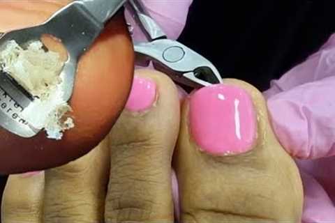 Pedicure | DIY Hard Dead Skin Removal