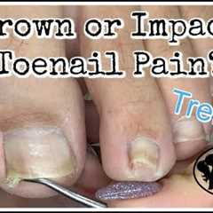 Impacted or Ingrown Toenail Pedicure Tutorial